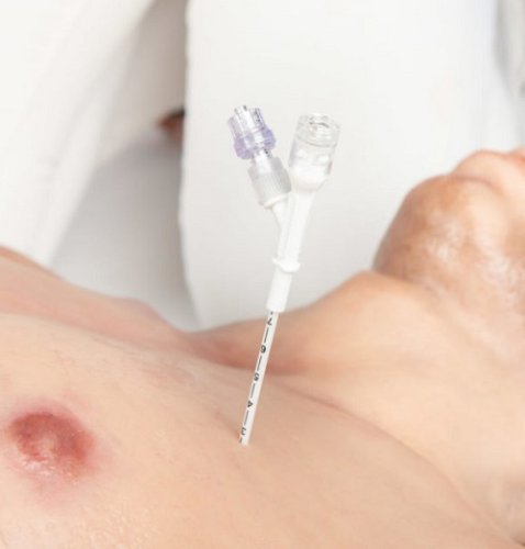 Dekompressziós tű Russell Pneumofix 12G Exp. 09/2025